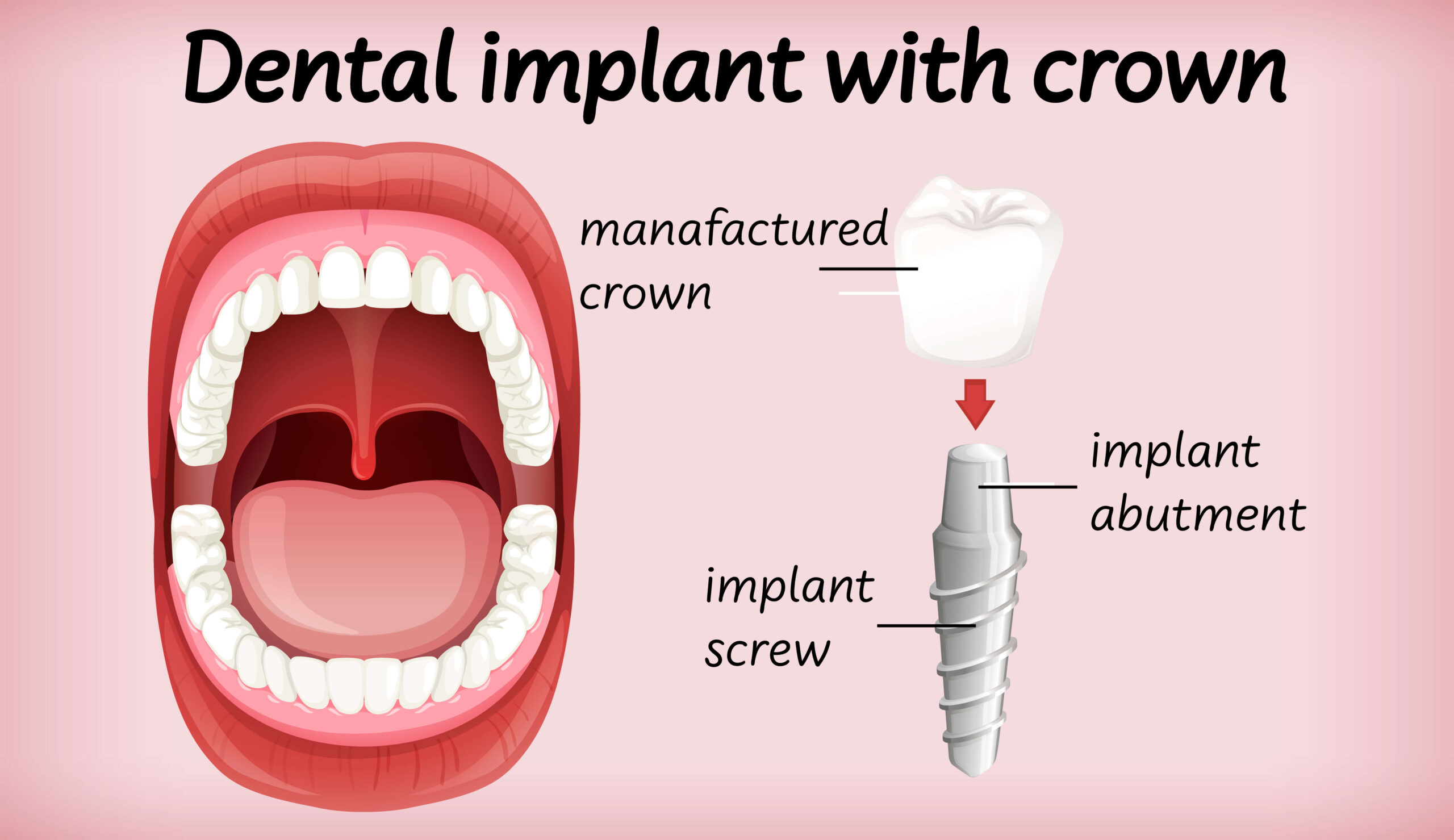 Dental Implant Parts article